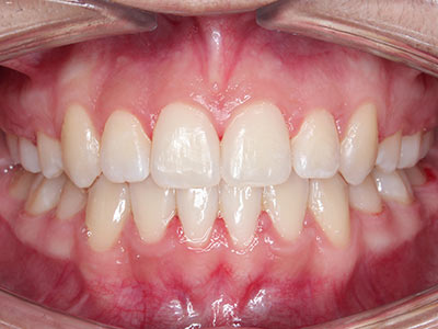 after Image