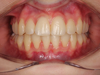 after Image